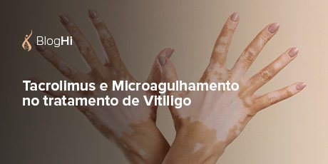 Terapias Usadas no Vitiligo Uso de Tacrolimus e Microagulhamento Auxilia nos Processos de Re-epitelização de Pacientes com Vitiligo